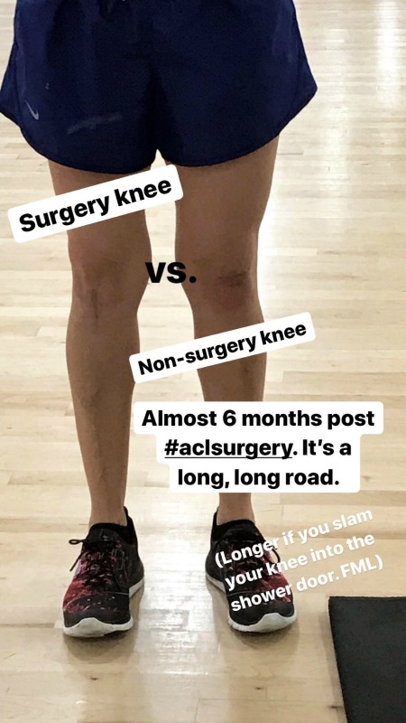 6 months post-ACL surgery